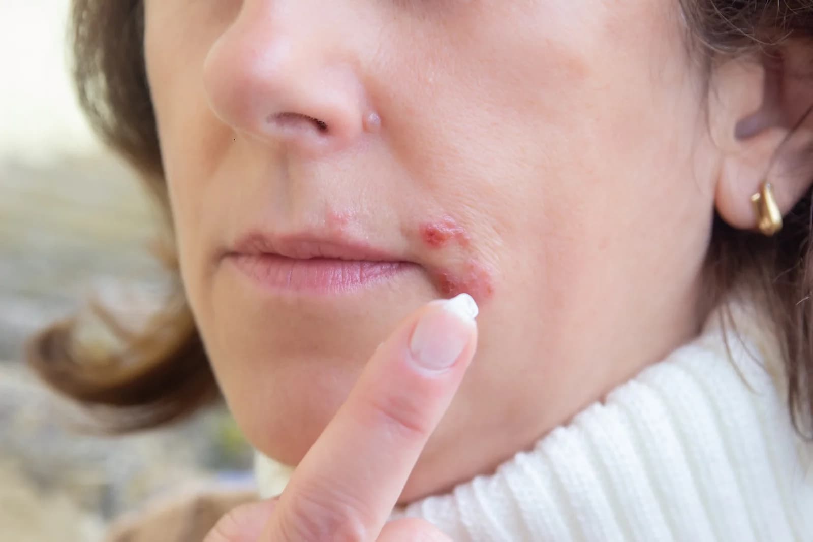 What does Lip Acne indicate?